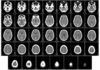 ‘Huellas’ de Alzheimer en ordenador Alzheimer en ordenador