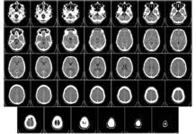 ‘Huellas’ de Alzheimer en ordenador Alzheimer en ordenador