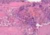Desvelan cómo el cáncer de próstata evade al sistema inmune Desvelan cómo el cáncer de próstata evade al sistema inmune