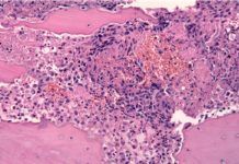 Desvelan cómo el cáncer de próstata evade al sistema inmune Desvelan cómo el cáncer de próstata evade al sistema inmune