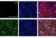 La primera terapia con células CAR-T erradica el cáncer de sangre La primera terapia con células CAR-T erradica el cáncer de sangre