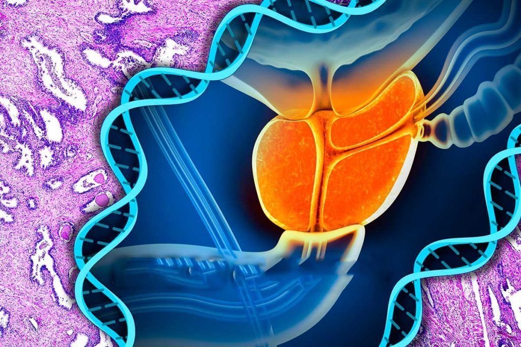 Detectan mutaciones en otros 11 genes asociados con el cáncer de próstata