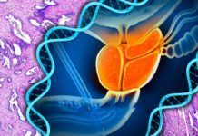 Un gen involucrado en el cáncer de mama también origina cáncer de próstata Detectan mutaciones en otros 11 genes asociados con el cáncer de próstata