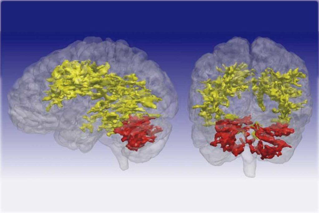 ¿Hay conexión entre trastorno bipolar y Parkinson?
