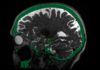 Ultrasonido de baja intensidad para tratar el Alzheimer Ultrasonido de baja intensidad para tratar el Alzheimer