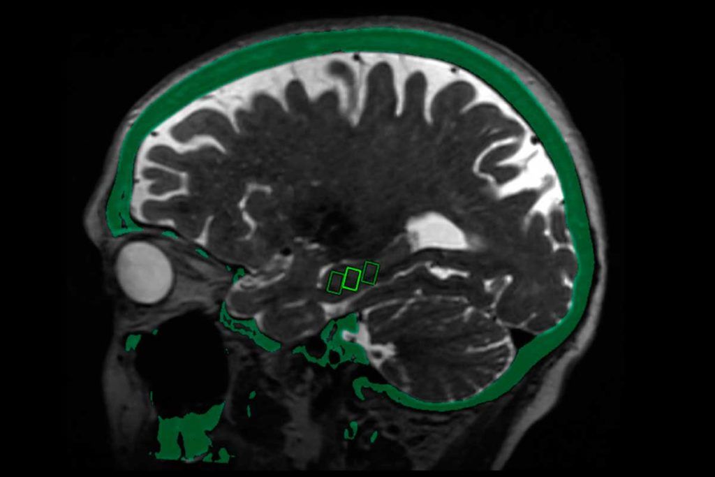 Ultrasonido de baja intensidad para tratar el Alzheimer