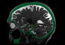 Ultrasonido de baja intensidad para tratar el Alzheimer Ultrasonido de baja intensidad para tratar el Alzheimer