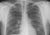 Consiguen revertir la fibrosis Consiguen revertir la fibrosis quística