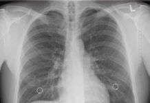 Consiguen revertir la fibrosis Consiguen revertir la fibrosis quística