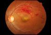 Hallan la causa de la degeneración de la retina Hallan la causa de la degeneración de la retina