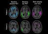 ‘Tau’ predice la evolución del Alzheimer ‘Tau’, la mejor para detectar Alzheimer