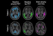 ‘Tau’ predice la evolución del Alzheimer ‘Tau’, la mejor para detectar Alzheimer