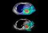 Protonterapia, menos efectos secundarios que la radioterapia en cáncer Protonterapia, menos efectos secundarios que la radioterapia en cáncer