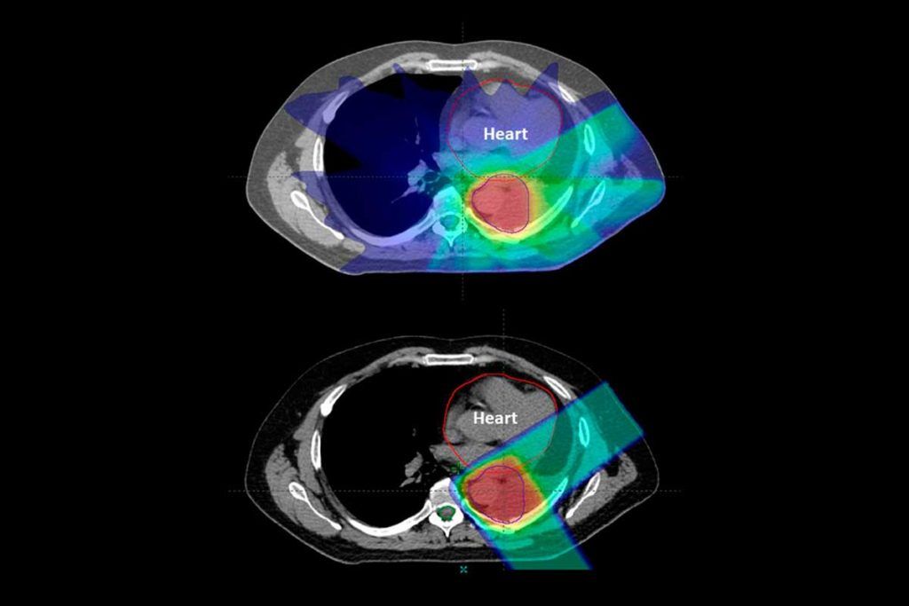 Protonterapia, menos efectos secundarios que la radioterapia en cáncer