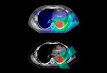 Protonterapia, menos efectos secundarios que la radioterapia en cáncer Protonterapia, menos efectos secundarios que la radioterapia en cáncer