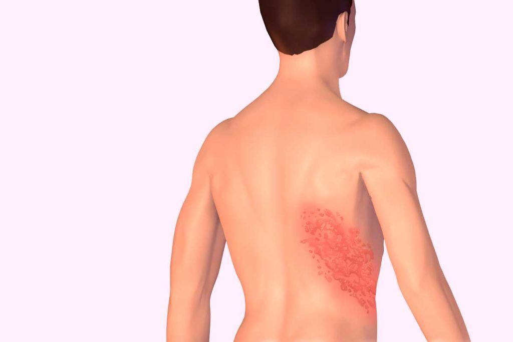 La vacuna del herpes zóster protege también contra el derrame cerebral