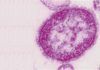 El virus del sarampión sigue extendiéndose por el mundo El virus del sarampión sigue extendiéndose por el mundo