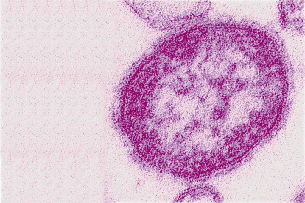 El virus del sarampión sigue extendiéndose por el mundo