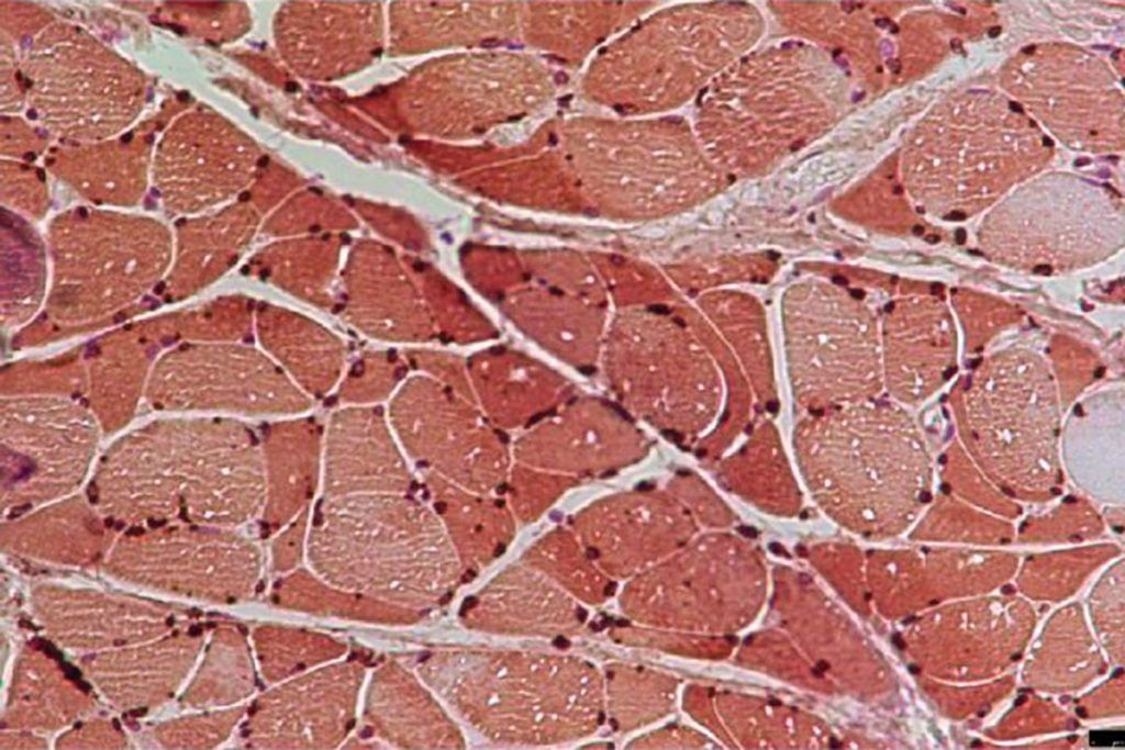 Caquexia: cómo el cáncer degrada la masa muscular