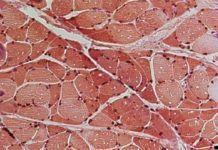 Caquexia: cómo el cáncer degrada la masa muscular Caquexia: cómo el cáncer degrada la masa muscular