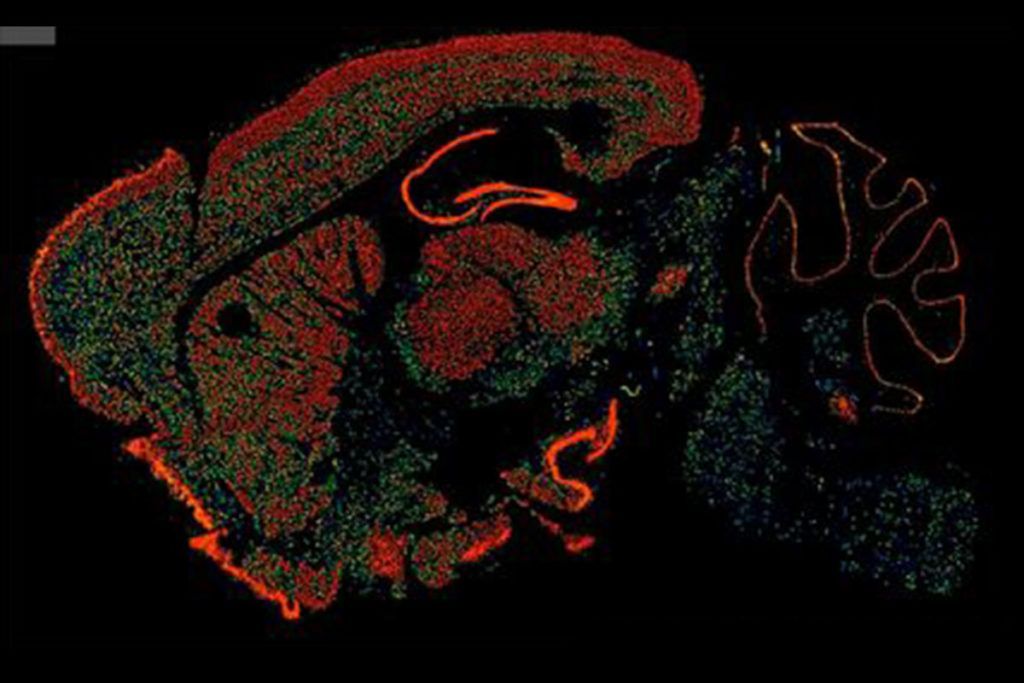 Colesterol cerebral y enfermedades neurodegenerativas