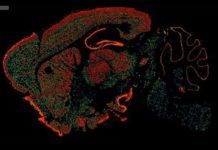 Mapa del colesterol cerebral y enfermedades neurodegenerativas Colesterol cerebral y enfermedades neurodegenerativas