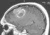 Fármaco antimalárico eficaz contra el glioblastoma multiforme Fármaco antimalárico eficaz contra el gliobastoma multiforme