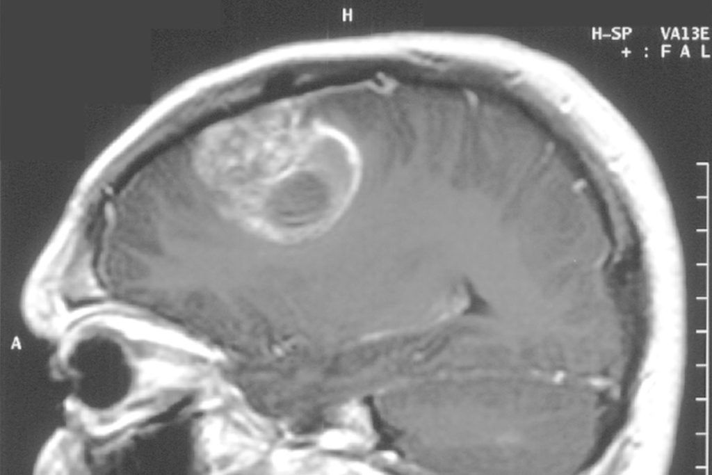 Fármaco antimalárico eficaz contra el gliobastoma multiforme