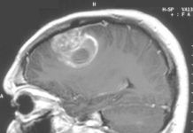 Fármaco antimalárico eficaz contra el glioblastoma multiforme Fármaco antimalárico eficaz contra el gliobastoma multiforme