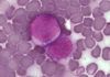 Hallan gen clave de la leucemia con ‘tijeras moleculares’ Hallan gen clave de la leucemia con ‘tijeras moleculares’