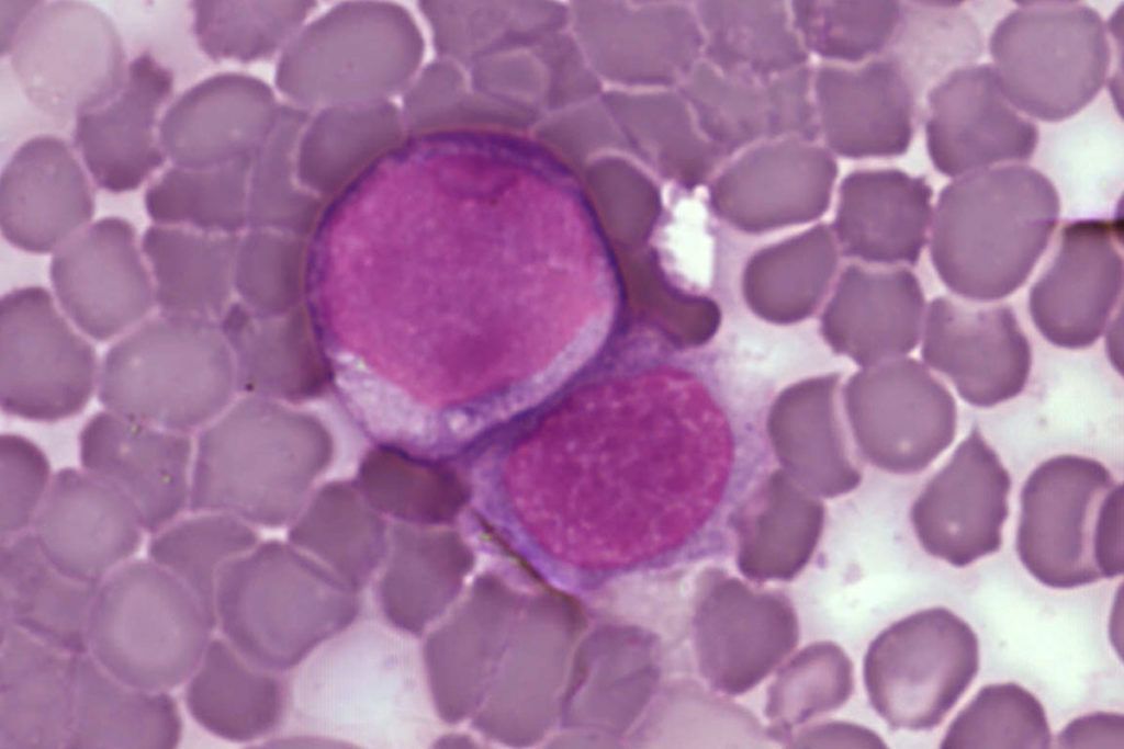 Hallan gen clave de la leucemia con ‘tijeras moleculares’