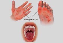 Nuevo candidato antiviral para boca-mano-pie Nuevo candidato antiviral para boca-mano-pie