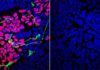Identifican un nuevo trastorno genético que afecta al cerebro Identifican un nuevo trastorno genético que afecta al cerebro