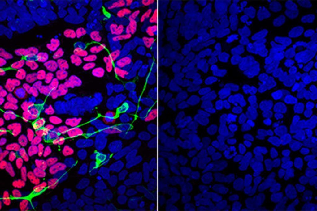 Identifican un nuevo trastorno genético que afecta al cerebro
