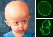 Progeria: prometedor método de edición de ADN Progeria: prometedor método de edición de ADN