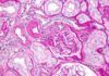 Biomarcador sanguíneo que predice rechazo al trasplante renal Biomarcador sanguíneo que predice rechazo al trasplante renal