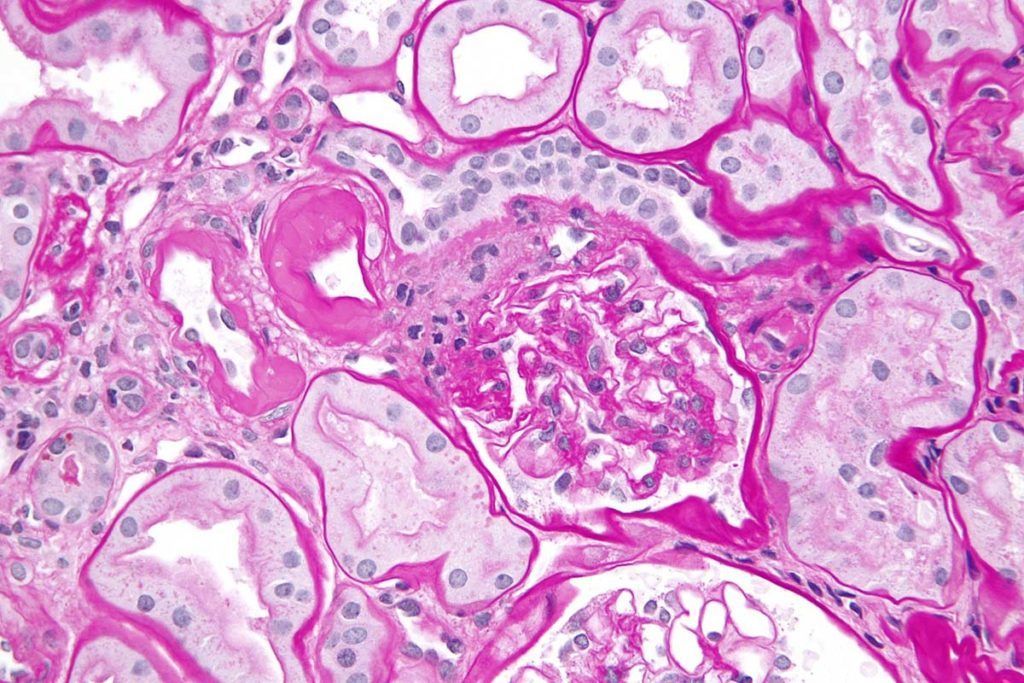 Biomarcador sanguíneo que predice rechazo al trasplante renal