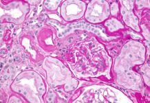 Biomarcador sanguíneo que predice rechazo al trasplante renal Biomarcador sanguíneo que predice rechazo al trasplante renal