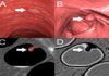 La radiómica permite ver pólipos precancerosos en el colon de forma no invasiva Ven pólipos precancerosos en el colon gracias a la radiómica