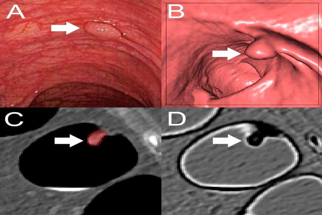 Ven pólipos precancerosos en el colon gracias a la radiómica