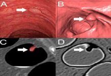 La radiómica permite ver pólipos precancerosos en el colon de forma no invasiva Ven pólipos precancerosos en el colon gracias a la radiómica
