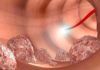 Uno de cada seis casos de cáncer colorrectal es genético Uno de cada seis casos de cáncer colorrectal es genético
