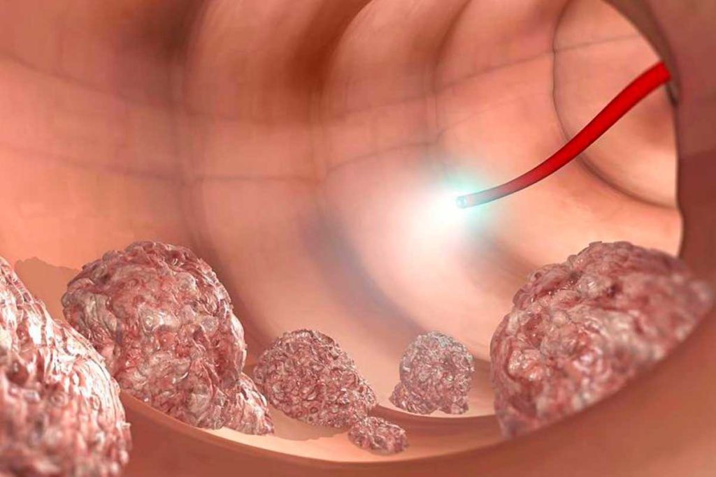 Uno de cada seis casos de cáncer colorrectal es genético