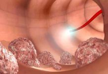 Uno de cada seis casos de cáncer colorrectal es genético Uno de cada seis casos de cáncer colorrectal es genético