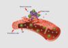 Tratan con éxito el cáncer de piel con nanopartículas Tratan con éxito el cáncer de piel con nanopartículas