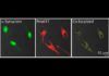 Encuentran vínculo molecular entre Parkinson y melanoma Encuentran vínculo molecular entre Parkinson y melanoma