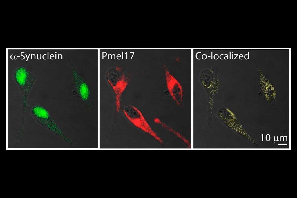 Encuentran vínculo molecular entre Parkinson y melanoma