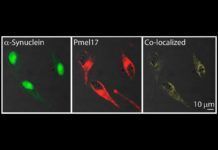 Encuentran vínculo molecular entre Parkinson y melanoma Encuentran vínculo molecular entre Parkinson y melanoma