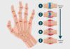 Artritis reumatoide: ¿dos enfermedades diferentes? Artritis reumatoide: ¿dos enfermedades diferentes?