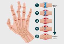 Artritis reumatoide: ¿dos enfermedades diferentes? Artritis reumatoide: ¿dos enfermedades diferentes?
